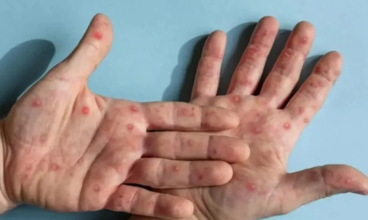 São Paulo registra primeiro caso de nova cepa de mpox no Brasil